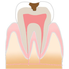 C2虫歯