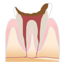 C4虫歯