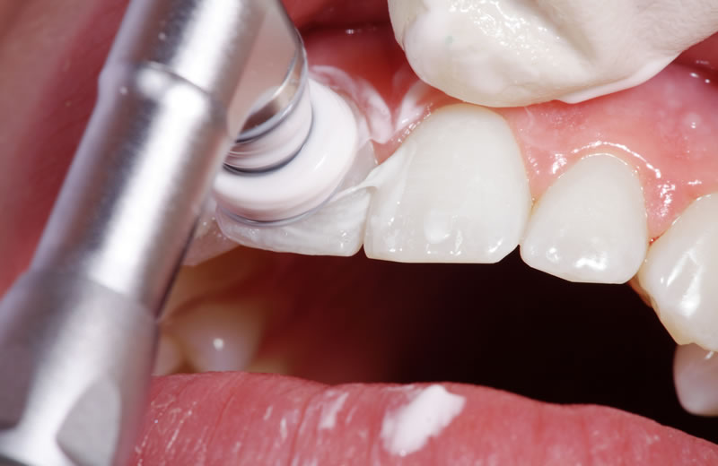 歯の表面のクリーニング