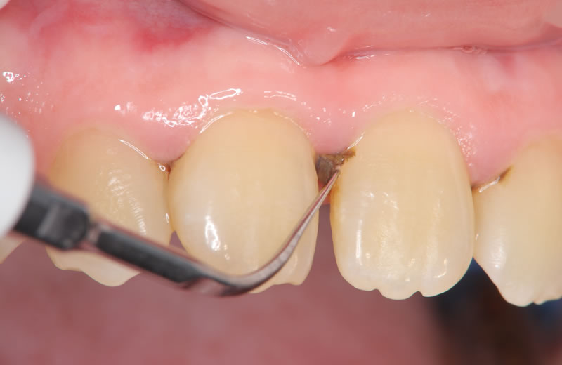 歯の隙間のクリーニング